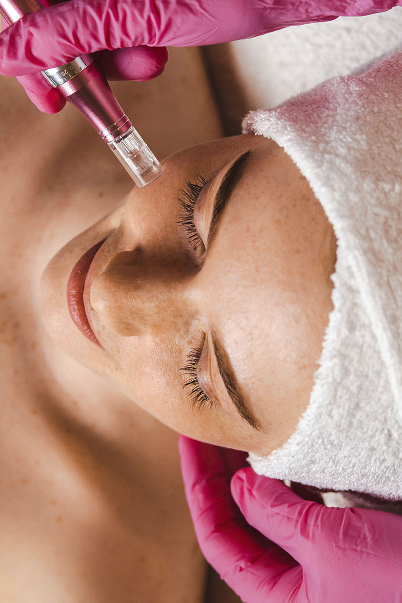 Microneedling auf der Wange einer Frau