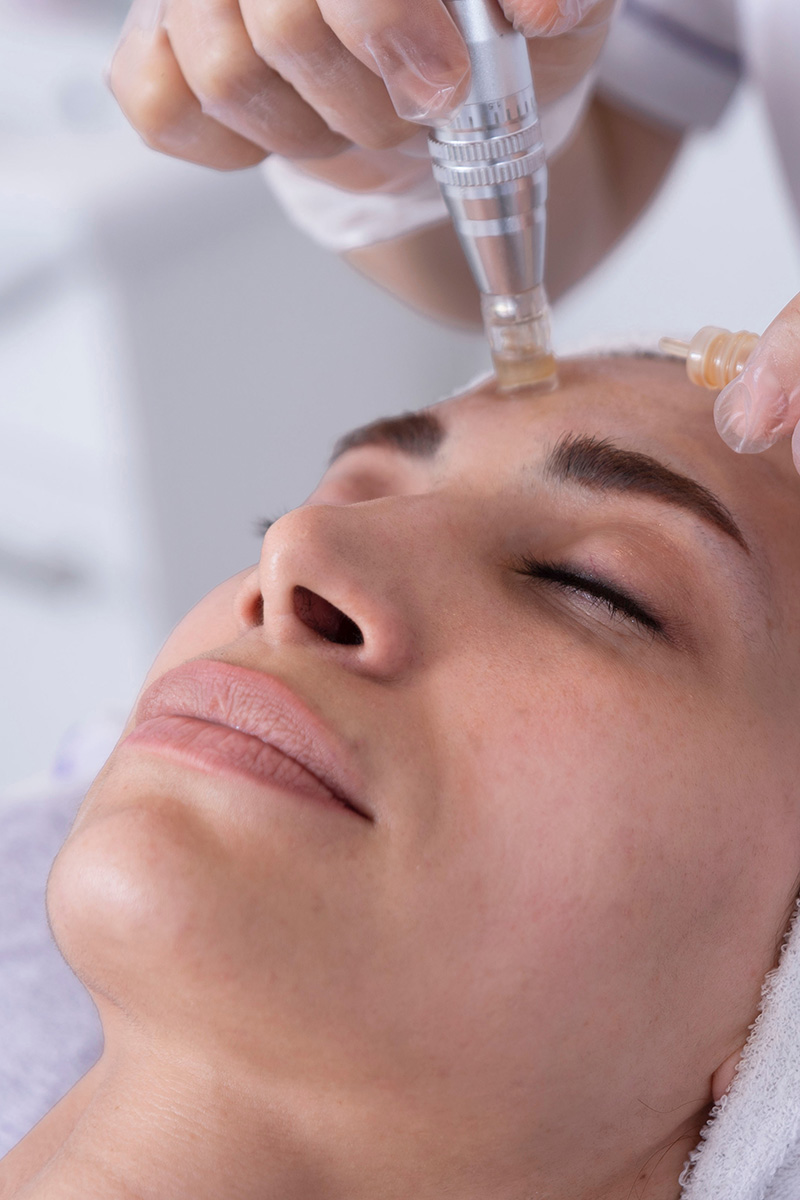 Microneedling auf der Stirn einer Frau